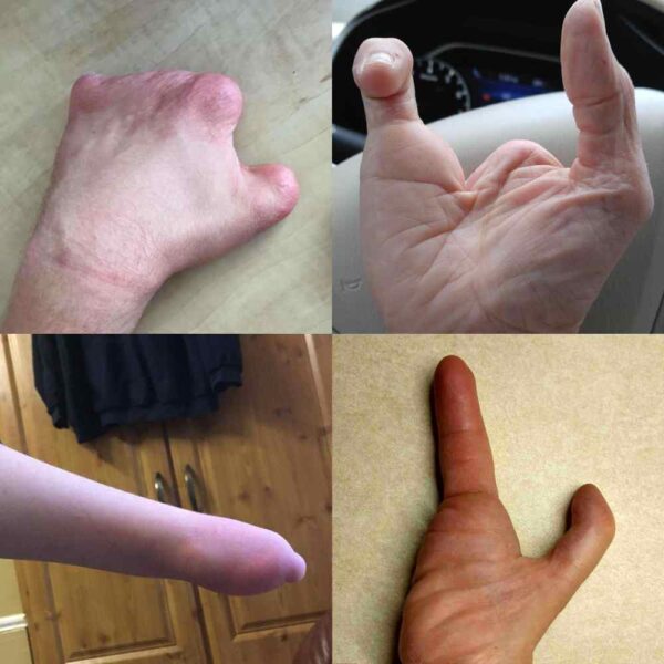 Image showing a wide variety of limb disabilites on the hand.