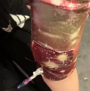 PICC line cover with a purple galaxy pattern on a woman's arm
