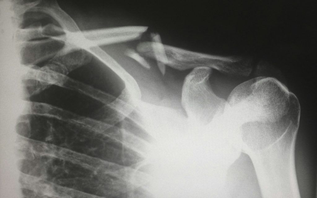 An X-ray image of a human shoulder and upper chest, showing a clearly fractured clavicle (collarbone) with the broken ends misaligned. The ribcage and upper arm bone (humerus) are also visible.